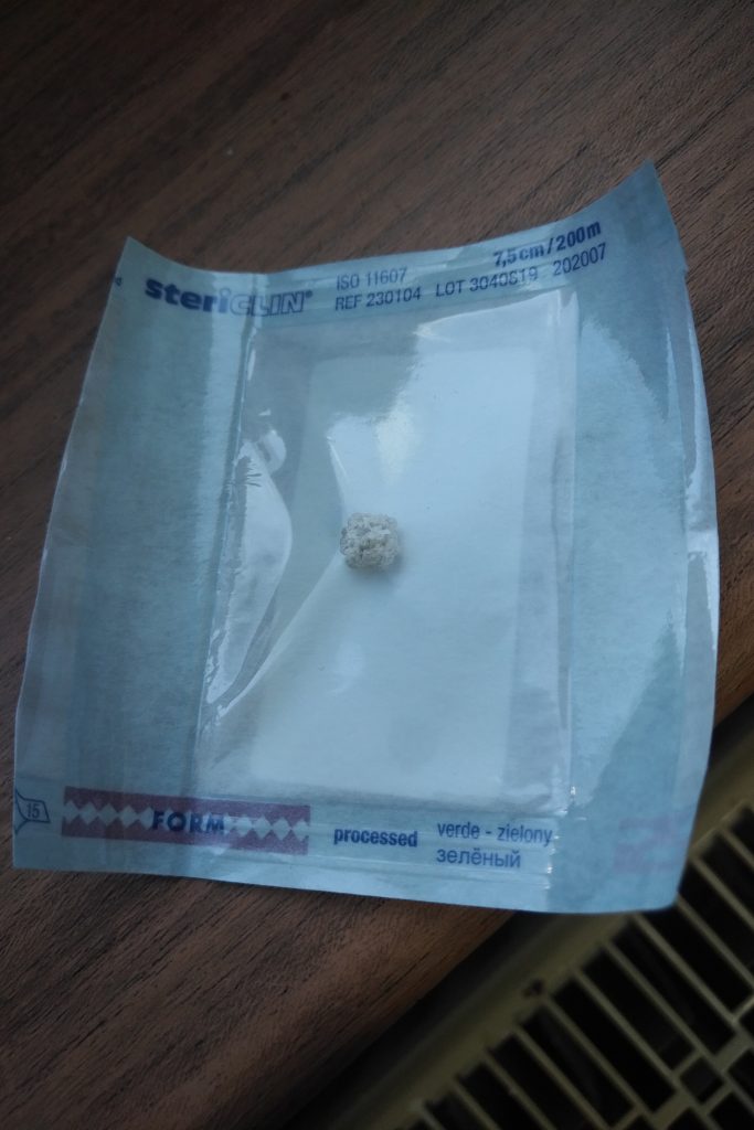 Bild eines herausoperierten Blasensteins mit einer rauhen, scharfkantigen Oberfläche